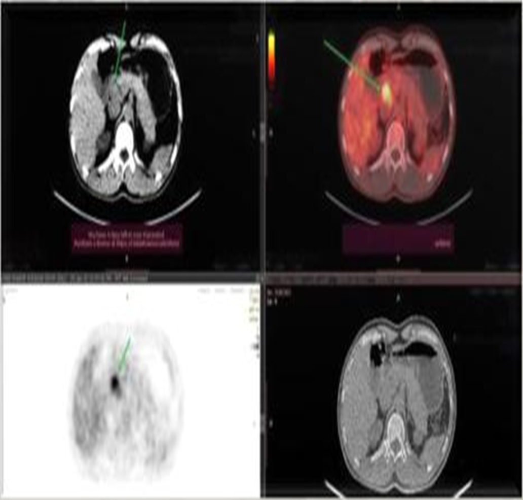 Anaplastic Large Cell LymphomaCT-SCAN_Thyroidgland